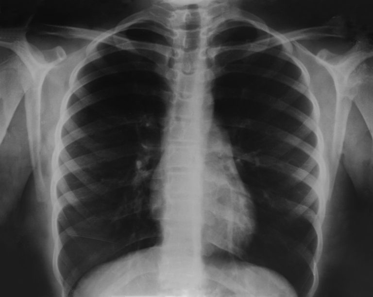 Chest XRay Dr Diana Holdright