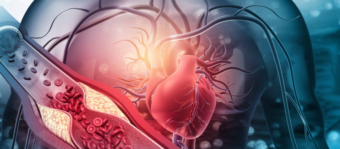 Human heart with blocked arteries. 3d illustration